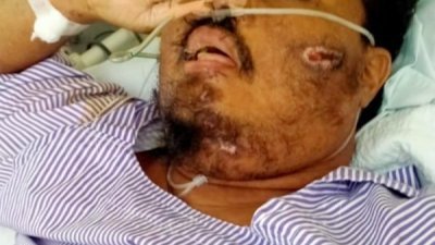 巫裔男子莫哈末法迪里于去年8月确诊冠病后，在医院昏迷21天。