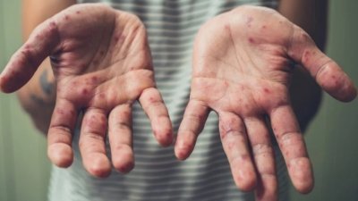 手足口症是由多种病毒感染引起，尤其是柯萨奇A16病毒和肠道病毒71（EV71），病毒通过唾液、水泡和粪便接触而传播。