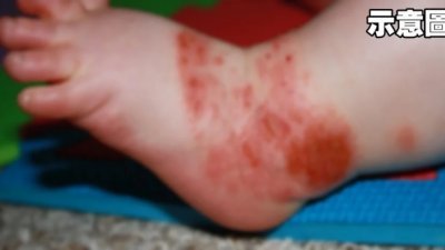 手足口症是一种常见于幼儿的轻度传染性病毒感染，以口腔溃疡和手足部皮疹为特征。