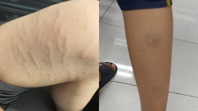 受访家长透露，有家长在群组发布最新照片，可见孩子大腿明显留下受刑痕迹。右图为一名中二生在学校受到霸凌，导致其后腿到脚根都能看见瘀青。