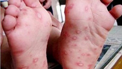 大部分手足口症感染者会出现轻微症状，例如手部、腿部、口腔会出现皮疹。