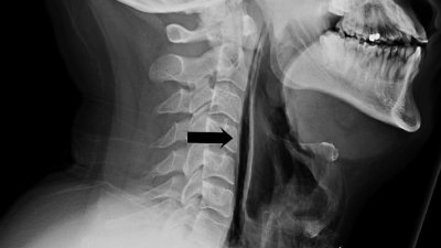男子的x光照显示，其喉咙气管出现撕裂。（图取自英国医学杂志官网）
