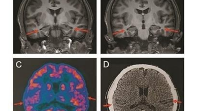论文中发布的患者脑部影像。
