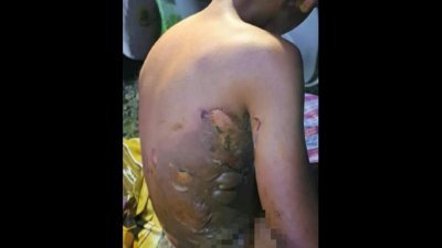 9岁男童被烧伤不获送院治疗，导致伤口恶化及发出异味。(笨珍警方)