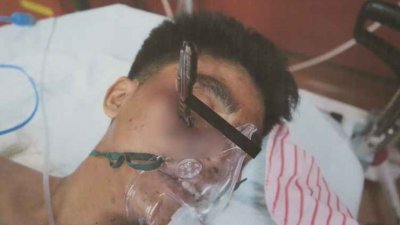 一名外籍男子疑发生醉酒殴斗后，脸部被一把折叠刀插入，非常骇人。