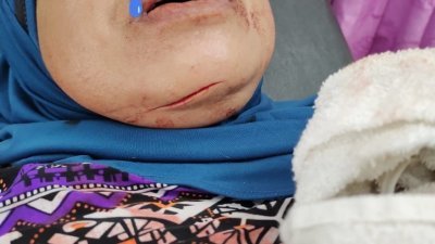 妇女的下巴被匪徒砍伤，留下一道很深的伤痕。