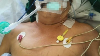 62岁华裔摩哆骑士于6月6日凌晨在交通事故在被撞倒昏迷不醒。