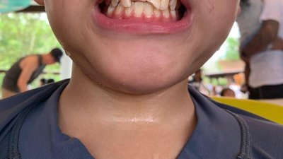 男童的2颗门牙被撞断，需要进行根管治疗。 （受访者提供）