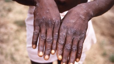 猴痘不再是一种仅限于非洲某些地区的罕见疾病，现已在世界许多地区出现人传人的状况。而皮疹是感染猴痘的症状之一。（图取自法新社）
