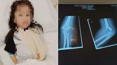 女童被撞倒后左手臂骨折，需戴护套长达3个月。 （档案照）