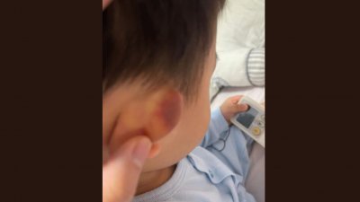 男童右耳有淤伤。 （受访者提供）