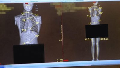 少年的X光照片显示，脊椎骨的侧弯程度在3个月内加剧了。 （受访者提供）