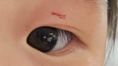 姐姐的左眼皮被咬后留下一道伤口。