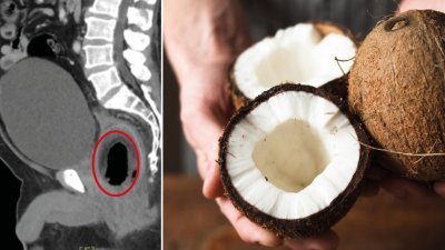 男子因无法排尿与严重腹痛到医院挂急诊，医生照电脑断层后发现直肠内竟有一颗椰子（左图）。右图为示意图。